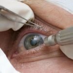 Oftalmologistas alertam para risco de suplementos com promessa de cura