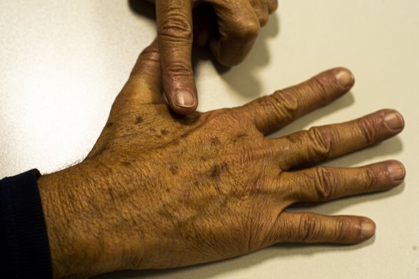 Sociedade Brasileira de Dermatologia promove mutirão gratuito para prevenção do câncer de pele